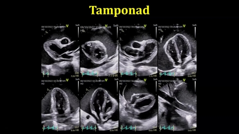 Thumbnail for Tamponad