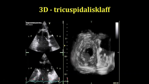 Thumbnail for Trikuspidalisklaff 3D