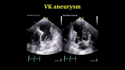 Thumbnail for VK-aneurysm