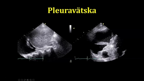 Thumbnail for Pleuralvätska