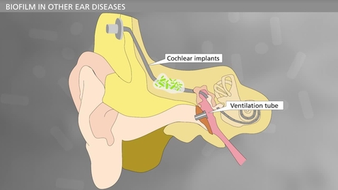Thumbnail for BIOFILM - Bacteria and Chronic Infections - Otitis Media