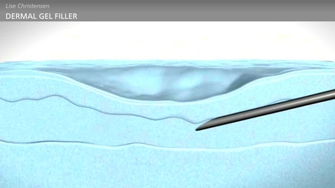 Thumbnail for BIOFILM - Bacteria and Chronic Infections - Tissue Fillers